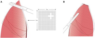 Safety assessment of poly-ε-caprolactone in the treatment of primary spontaneous pneumothorax